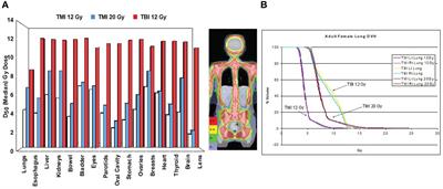 Total marrow irradiation (TMI): Addressing an unmet need in hematopoietic cell transplantation - a single institution experience review